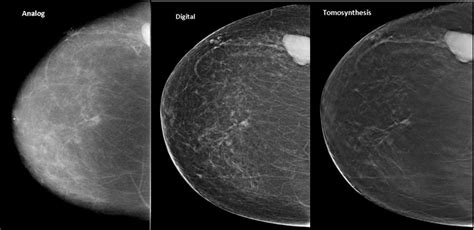 3d Mammography Tomosynthesis Diagnostic Mammogram Densebreast Info