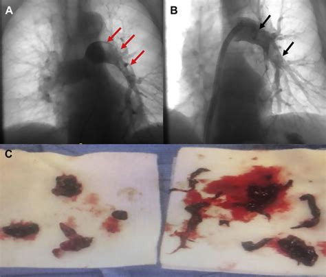 Difficulties Of Managing Submassive And Massive Pulmonary Embolism In The Era Of COVID JACC