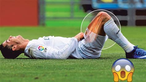 Football Injuries In 21st Century Terrible And Horrible ☹️☹️injures In
