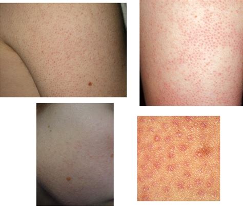 Do You Have Bumps On Your Arms Maybe Its Keratosis Pilaris Myskinandco