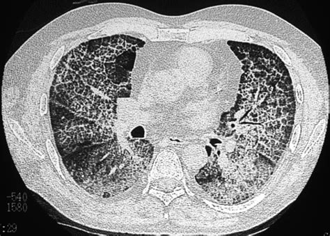 Disease Interlobular Septa Lungs