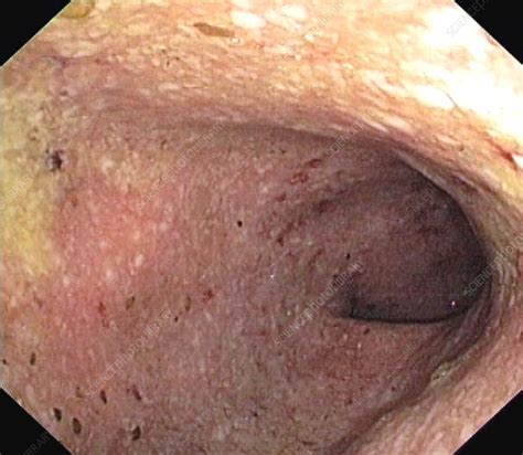Ulcerative Colitis Of The Sigmoid Colon Stock Image C001 2668