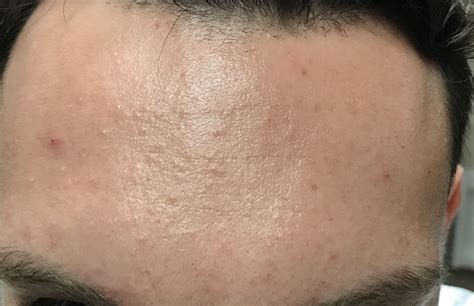 Small Bumps All Over Forehead Folliculitis General Acne Images And