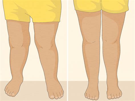 How To Fix Knock Knees 12 At Home Methods Simpler Lifestyle Lifestyle
