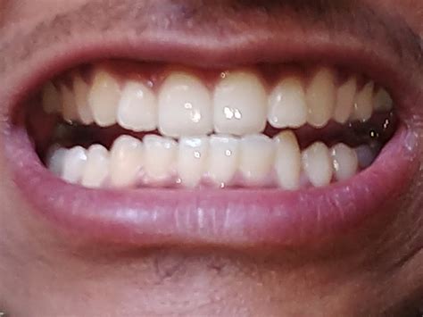 Normal Teeth Or Bite Problem Dentistry Forums