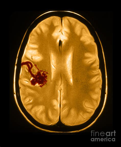 Mri Of Arterial Venous Malformation Photograph by Medical Body Scans