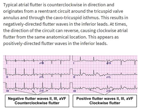 Atrial Flutter Classification Causes Ecg Diagnosis Management Ecg Learning Kulturaupice