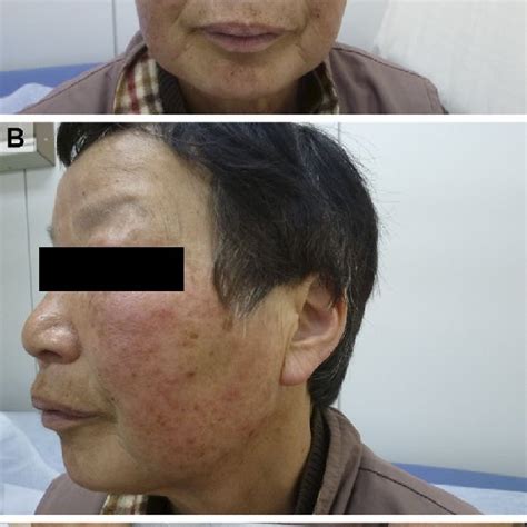 Figure1maculopapular Rash In A Patient On Ldvsof The Patient