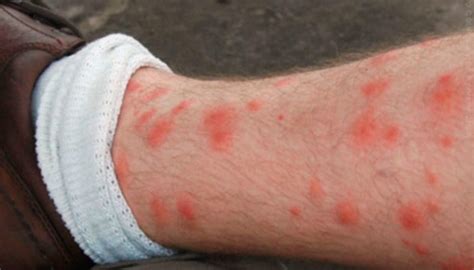 How To Get Rid Of Chiggers And Their Bites Bigbear Pest Control