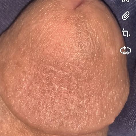 Dozens Of Bumps On Penis Glans Please Help Penis