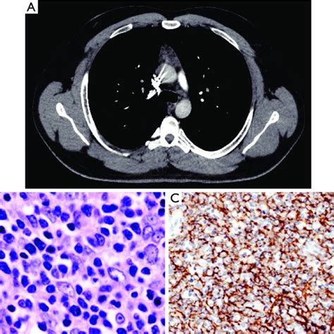 Transthoracic Fine Needle Aspiration Specimens From A Thymoma Type A