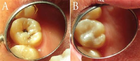 Interim Therapeutic Restorations Dimensions Of Dental Hygiene