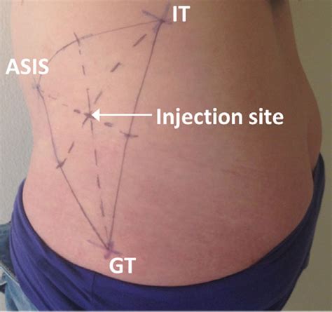 comparison of the g and v methods for ventrogluteal site identification muscle and subcutaneous