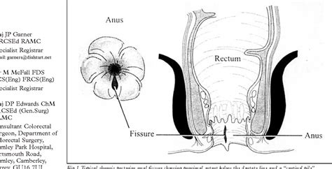 Figure 1 From The Medical And Surgical Management Of Chronic Anal