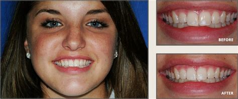 Cosmetic Tooth Bonding In Plano Tx Dr Mark Sowell