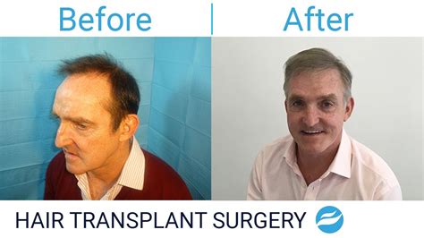 Hair Transplant Patient Testimonial BEFORE AFTER YouTube