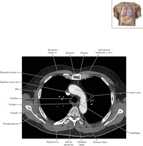 Cisterna Chyli And Thoracic Duct Radiology Key