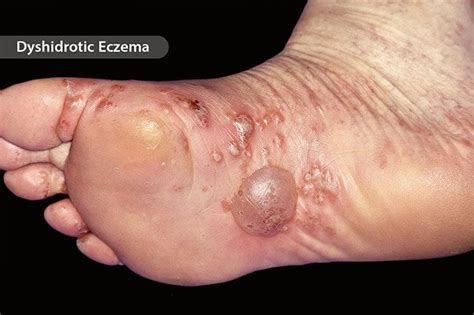 Skin Problems Blisters Causes And Treatment