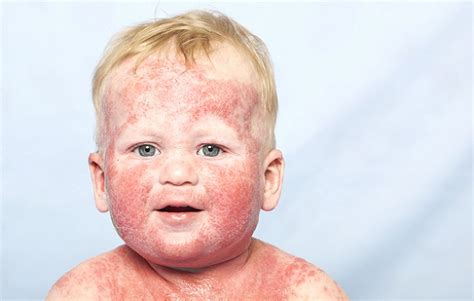 Er zeichnet sich durch rötung der haut und schuppenkrusten aus. Neurodermitis bei Babys und Kleinkindern: Ursachen ...
