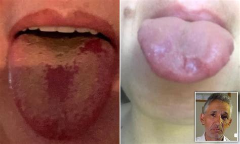 Nhs Urged To Recognise Covid Tongue As Official Sign Of The Disease