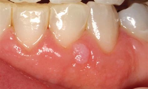 Hpv 3 Dimensions Of Dental Hygiene Magazine