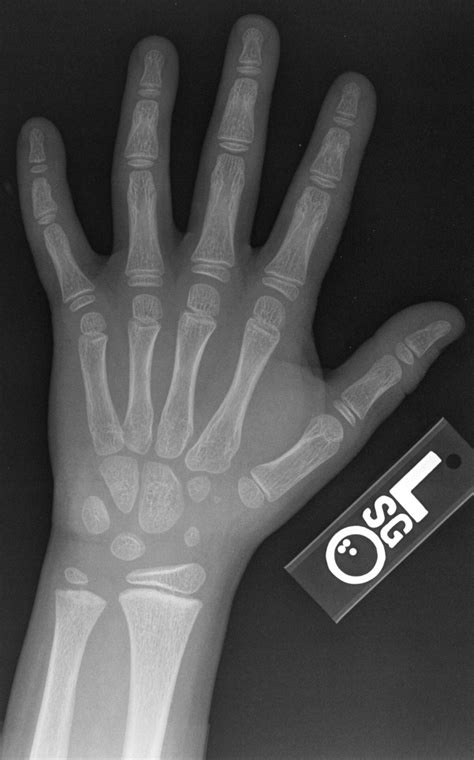 Patient punched a wall with both hands. File:X-ray of the hand of a 9 year old male - case 2 ...