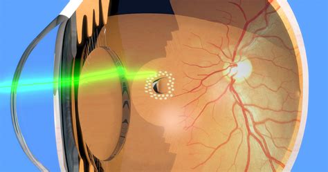 Panretinal Photocoagulation Eye Patient