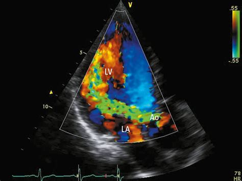 Transthoracic Echocardiography Shows A Severe Aortic Stenosis With