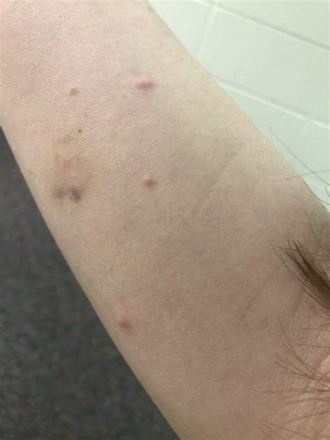Do These 3 Raised Bumps Look Like Bed Bug Bites The Bruise Is