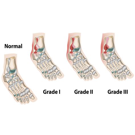 Ankle Sprains Orthopedics Sports Medicine