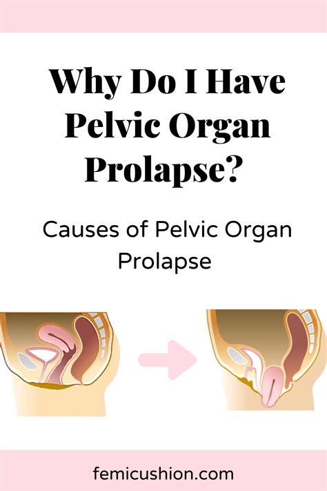 Causes Of Pelvic Organ Prolapse POP Pelvic Organ Prolapse Pelvic Floor Exercises For