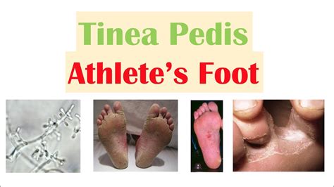 Athletes Foot Tinea Pedis Causes Risk Factors Signs And Symptoms