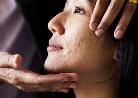 Acne Scars Essex Treat Acne Scars Acne Scars Dr Bawa Time Clinic