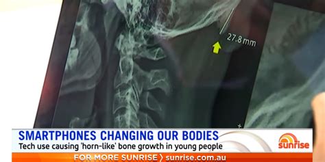 Phone Bones Researchers Say Young People Are Growing Head Horns From