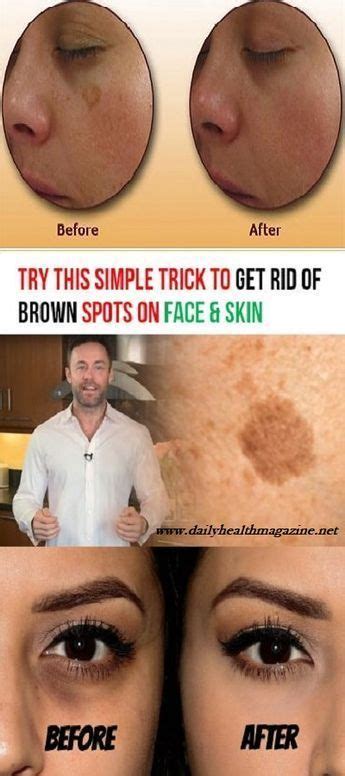 Try This Simple Trick To Get Rid Of Brown Spots On Face And Skin Brown