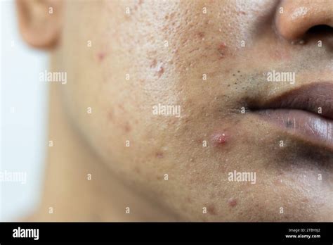 Skin Problems Problem Of Inflamed Acne On The Face Inflamed Acne