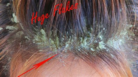 Huge Flakes Picking Psoriasis Flakes Scratching On Scalp And Comb