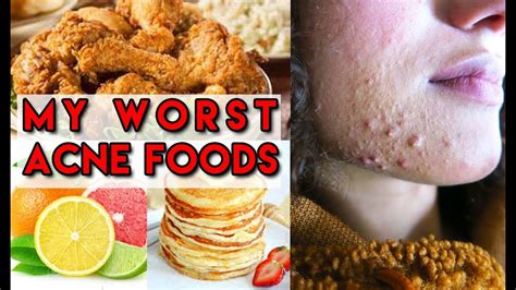 Foods That Cause Acne Top 10 Antibacterial Foods For Acne