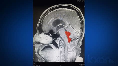 Tapeworm Removed From Austin Mans Brain After Months Of Headaches