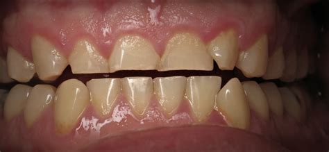 Teeth Grinding Pictures