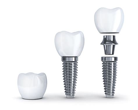 Longevity Of Dental Implants Charleston Mountain State
