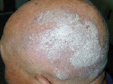 How To Treat Scalp Psoriasis Dorothee Padraig South West Skin Health Care
