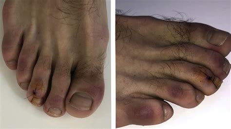 Coronavirus People Who Contract Covid May Develop Red And Swollen Toes