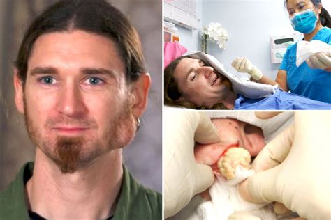 Dr Pimple Popper Squeezes ‘jaw Breaking Cyst That Leaves Oatmeal Like Pus Oozing From His