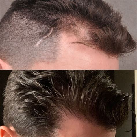 Hair Transplant Before After New Photos Home Design Ideas
