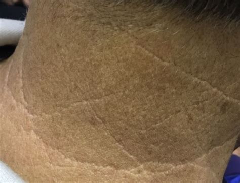 Derm Dx Furrows And Thickened Skin On The Posterior Neck Clinical