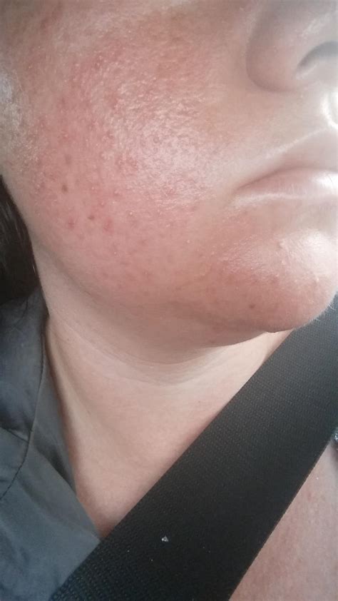 Does This Look Like Folliculitis Pictures Attached General Acne Discussion Acne Org Forum