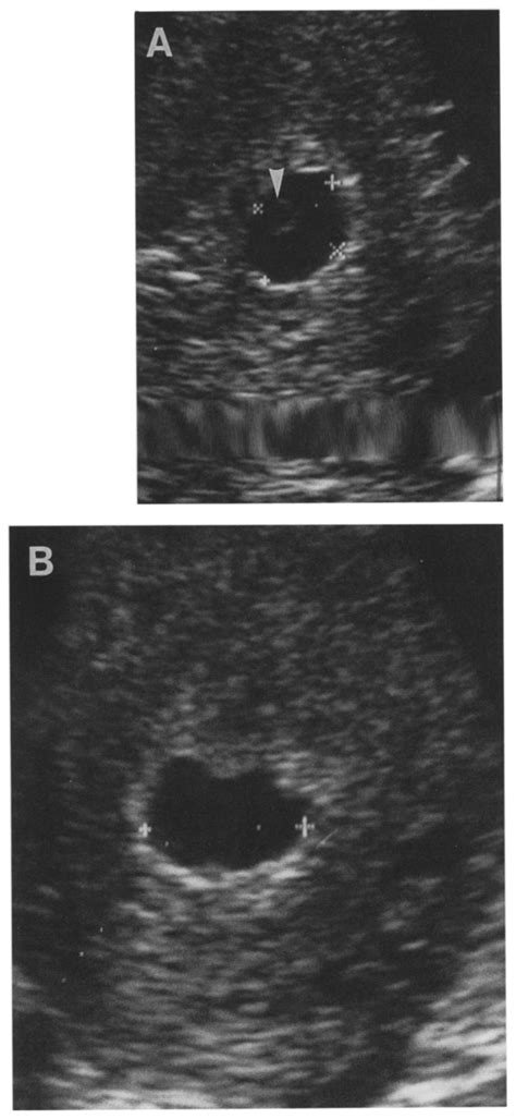 Gestational Sac Transvaginal Sonogram At Slightly Less Than 5 Weeks