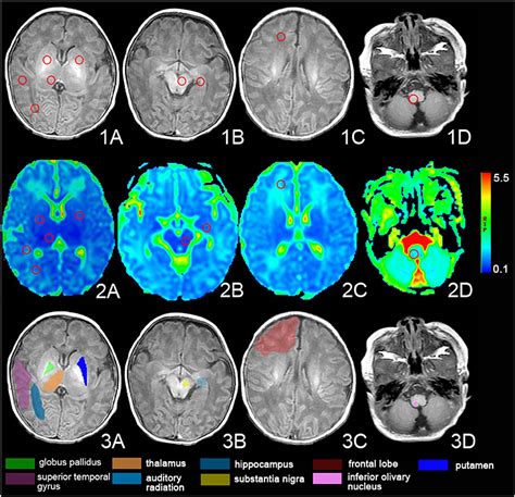 Frontiers Magnetic Resonance Image Of Neonatal Acute Bilirubin