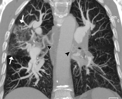 Ct Diagnosis Of Chronic Pulmonary Thromboembolism Radiographics